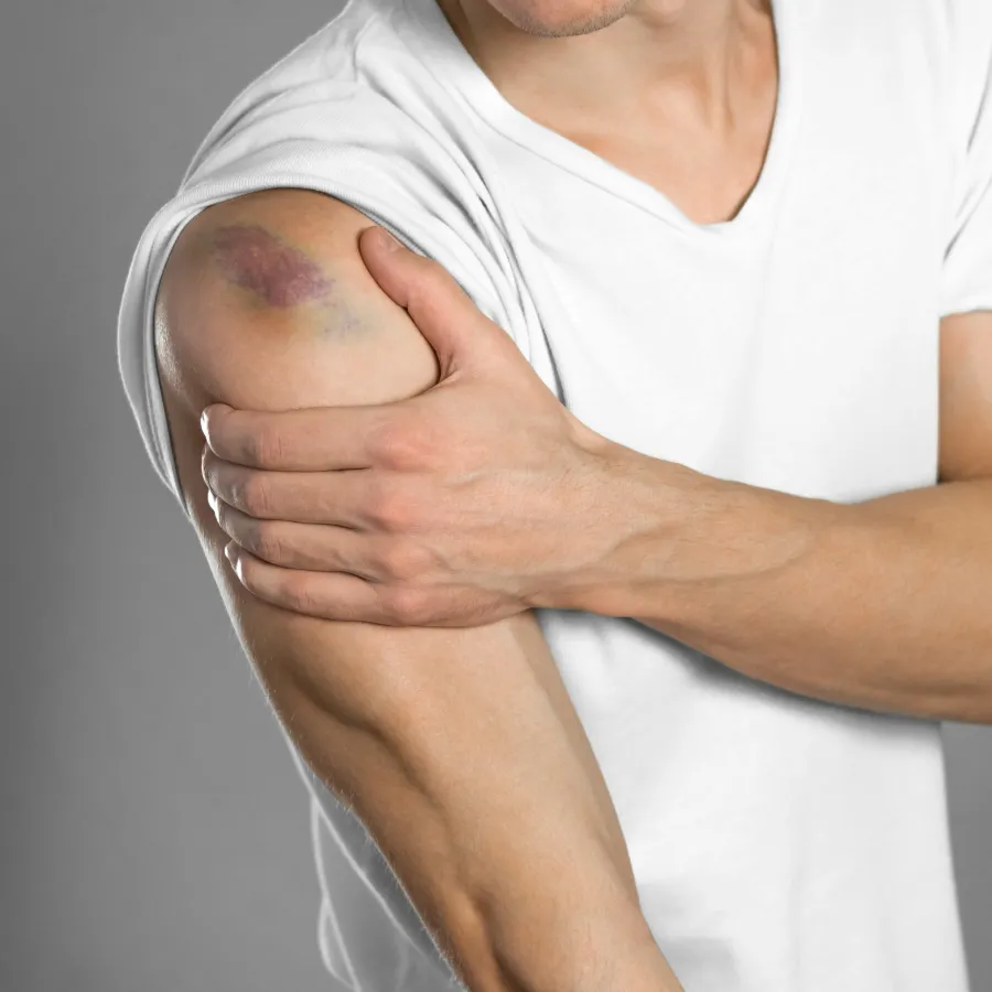 a bruised shoulder