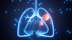 Digital illustration of human lungs highlighting tumors with glowing blue background and particles.
