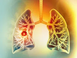 Illustration of human lungs with highlighted tumor inside left lung showing respiratory anatomy and disease.