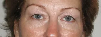 Before Room for eyeshadow!  Upper blepharoplasty and laser resurfacing open these eyes and tigthten the lower eyelid skin.