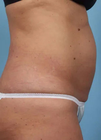 Before This 37 year old female had 4 cycles of CoolSculpting on her abdomen.  Her “after” photos were taken only 30 days after her treatment.