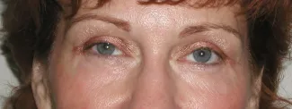 After Room for eyeshadow!  Upper blepharoplasty and laser resurfacing open these eyes and tigthten the lower eyelid skin.