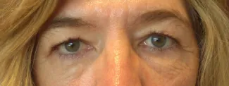 Before Upper eyelid blepharoplasty removed the extra skin and fat from the eyelids and made the eyes appear more open.