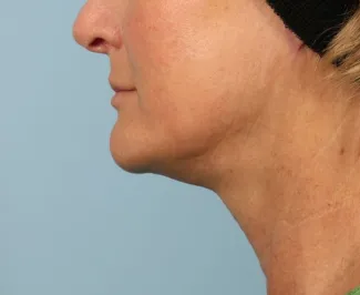 After A high SMAS left as part of Dr. Kavali's facelift surgery gives this Atlanta woman a tighter neck, jawline and lower face.  She is shown about 6 months after surgery.