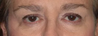 Before Upper blepharoplasty surgery was done by Dr. Kavali to remove extra skin and fat from the eyelids.  A browlift would complete this transformation and lift the eyes even more.