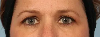Before Upper eyelid blepharoplasty gave this woman a brighter look.
