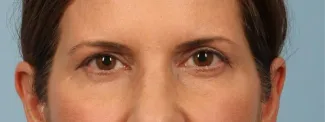 Before This Atlanta woman had an upper blepharoplasty and a browlift to rejuvenate her eye appearance.