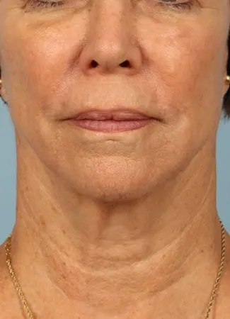 After Ulthera gave this woman a tighter jawline and slimmer neck contour.  Note how it also tightened her neck bands.
