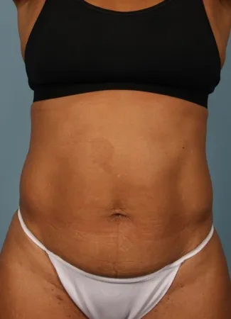 Before This woman has had prior pregnancies, but wanted a smaller abdominal contour.  She had 6 cycles of CoolSculpting for her abdomen and waist. 