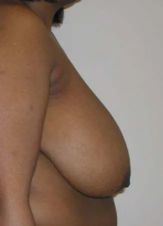 Before This 35 year old female desired relief from back pain and shoulder pain due to her heavy breasts.  Dr. Kavali performed a SPAIR short scar breast reduction technique and removed about 700 grams from each breast.  Her “after” photos were taken about 6 months after surgery.