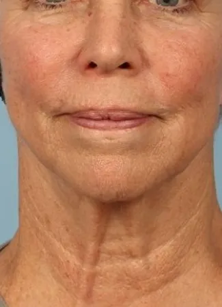 Before Ulthera gave this woman a tighter jawline and slimmer neck contour.  Note how it also tightened her neck bands.