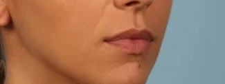 Before After 1 syringe of Juvederm Ultra Plus to lips