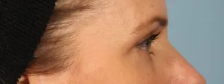 After Note the skin that is no longer sitting on the eyelash line.  After upper blepharoplasty surgery with Dr. Kavali, there is normal space now between the lashes and the skin.