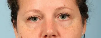 Before This woman wanted to correct the hollows under her eyes. We used one syringe of Juvederm Vollure and one syringe of Juvederm Ultra to get this beautiful result. The 