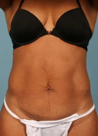 After This woman has had prior pregnancies, but wanted a smaller abdominal contour.  She had 6 cycles of CoolSculpting for her abdomen and waist. 