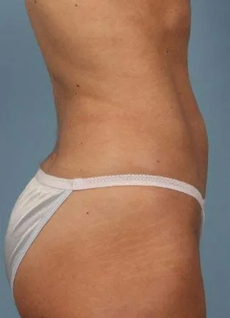 After This Atlanta woman chose CoolSculpting to contour her abdomen. She is shown 2 months after her treatment was completed.