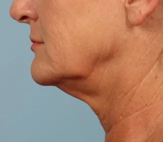 Before Neck contouring by Dr. Kavali.  This woman had a facelift with necklift to meet her goals.