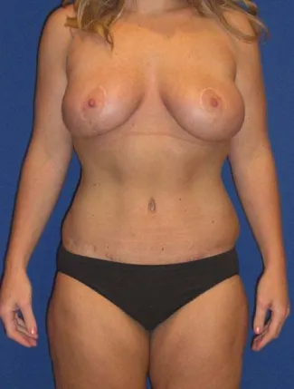 After This 27 year old woman lost 90 pounds after gastric bypass surgery.  She wanted to have a tighter tummy, fuller and rounder breasts, and smaller thighs.  Dr. Kavali performed an abdominoplasty with liposuction of the hips and waist, a breast augmentation with 339 cc gel implants, a breast lift (mastopexy), and liposuction of the inner and outer thighs.