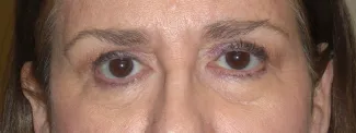 After Upper blepharoplasty surgery was done by Dr. Kavali to remove extra skin and fat from the eyelids.  A browlift would complete this transformation and lift the eyes even more.