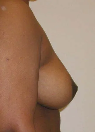 After This woman wanted a breast lift and didn’t want to be larger.  She had a SPAIR short scar breast lift with no implants.  Her “after” photos were taken about 6 months after surgery.