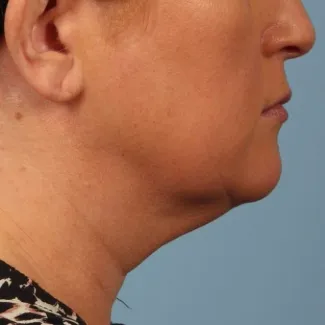 Before Results after 2 Kybella treatments