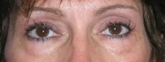 After This woman was concerned about heavy upper eyelids and underwent an upper blepharoplasty with Dr. Kavali to remove the extra skin.
