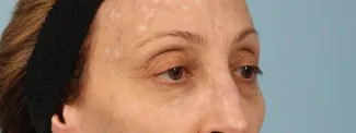 After Botox softens lines caused my muscle movement and can brighten a face by removing shadows caused by lines and creases.  Botox was used here between the brows and for the crows' feet (smile lines).
