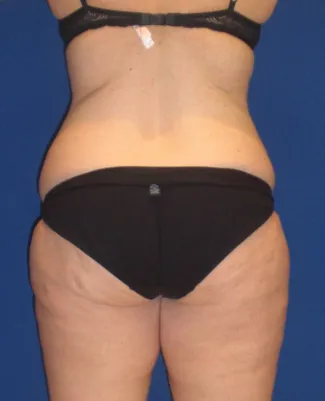 Before This Georgia mom had an abdominoplasty (tummy tuck) to remove loose skin and tighten her tummy muscles. She also had liposuction of her waist at the same time.  She is shown about 1 year after surgery.