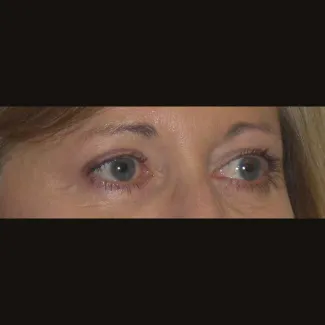 After This 50 year old female had upper blepharoplasty to remove extra fat and skin in the upper eyelids.  Her surgery was done in the office under local anesthesia.
