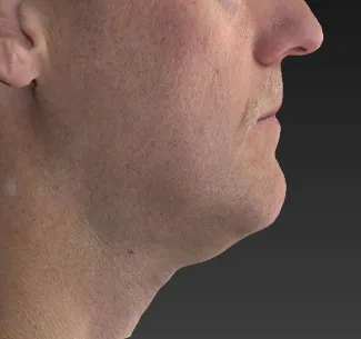 Before Note the improved contour of the jawline and the decreased fullness under the chin after an Ulthera treatment.