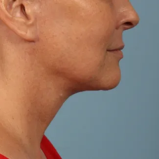 After This woman met her goals with Dr. Kavali by having a facelift with necklift to tighten her jawline and neck.