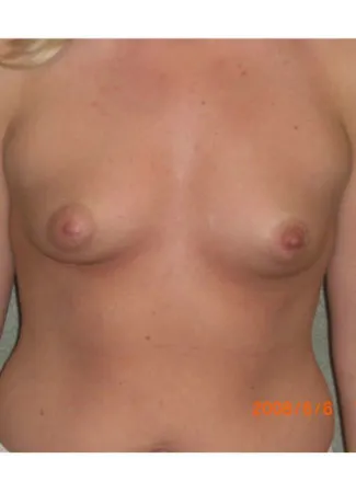 Before This 25 year old female chose 425 cc silicone gel implants. They were placed under the muscle using an incision around the areola, in order to correct her tuberous (constricted) breast shape. Her “after” photos were taken about 3 years after surgery.