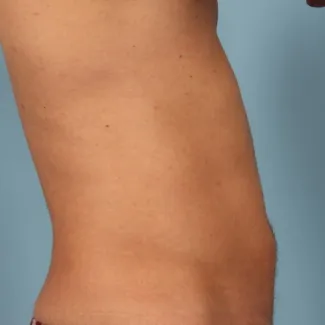 After This Atlanta man chose CoolSculpting to contour his abs and waist. He is shown about 2 months after his treatment.