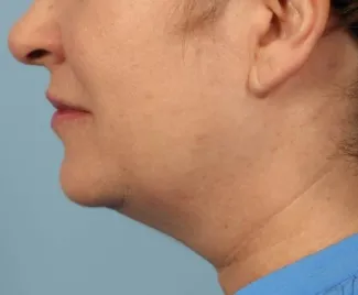 Before Results after two Kybella treatments