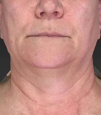 Before Ulthera gave this woman an amazing result!  No other treatments were done.  Ulthera alone is responsible for this tighter, slimmer neck and jawline!