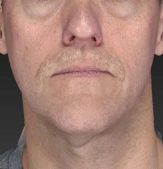 Before A slimmer, more taut jawline is shown here after an Ultherapy treatment.