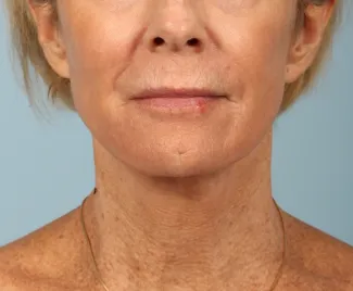 After This woman underwent a facelift and necklift using a high SMAS lift technique.  She also had a chemical peel done at the same time (a TCA peel) to brighten her skin.  She is shown about 6 months after surgery.