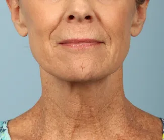 Before This woman underwent a facelift and necklift using a high SMAS lift technique.  She also had a chemical peel done at the same time (a TCA peel) to brighten her skin.  She is shown about 6 months after surgery.