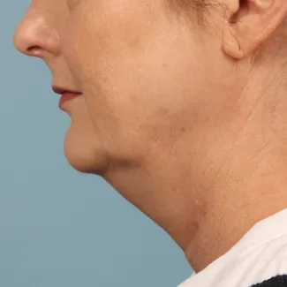 Before Results after 3 Kybella Treatments