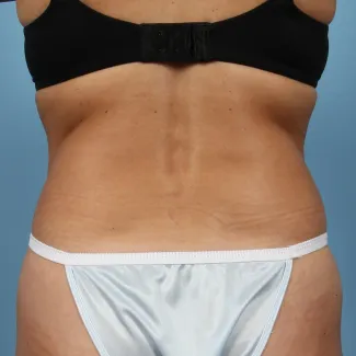 Before This 40 year old Atlanta female chose CoolSculpting to contour her back and bra rolls.  She had 2 cycles of treatment on her lower back and is shown about 3 months after that treatment.