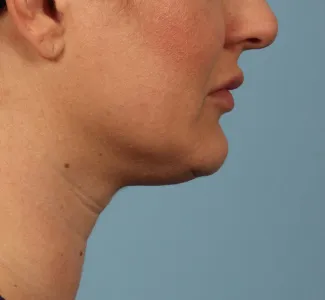 Before Results after a single treatment with Kybella