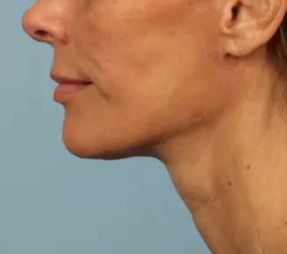 After A beautiful necklift and facelift with Dr. Kavali to tighten and define the jawline, neck, and lower face.