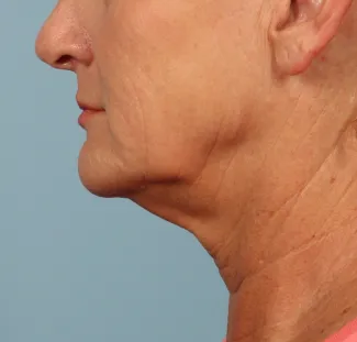 Before A high SMAS left as part of Dr. Kavali's facelift surgery gives this Atlanta woman a tighter neck, jawline and lower face.  She is shown about 6 months after surgery.