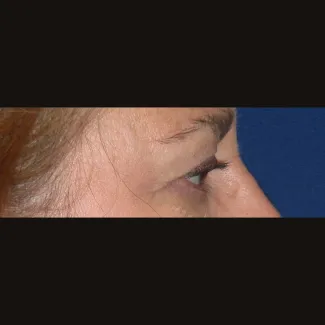 Before This 61 year old female had upper eyelid contouring (blepharoplasty) to remove extra fat and skin from her upper eyelids.