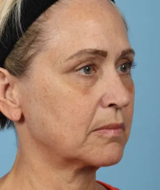 Before This 56 year-old Atlanta woman had a consultation with Dr. Kavali and decided to have Voluma for facial volume replacement.  She is shown after having 4 syringes of Voluma.