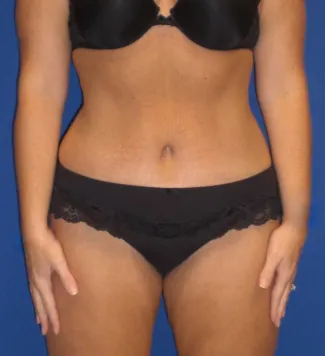 After This Georgia mom had an abdominoplasty (tummy tuck) to remove loose skin and tighten her tummy muscles. She also had liposuction of her waist at the same time.  She is shown about 1 year after surgery.
