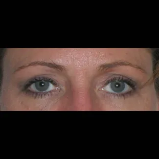 After This 50 year old female wanted a more “open” look to her eyes.  She had an upper blepharoplasty to remove excess skin and fat from her upper eyelids.  Her “after” photos were taken about 1 year after surgery.