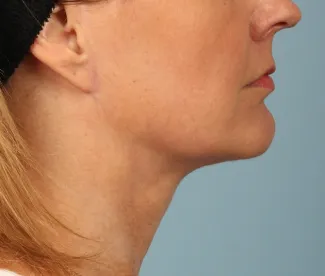 After Another beautiful necklift result from Dr. Kavali.