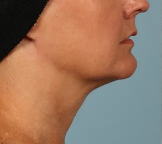 Before Another beautiful necklift result from Dr. Kavali.