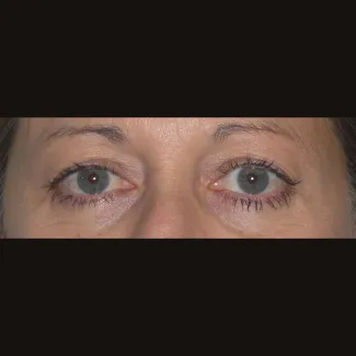 Before This 50 year old female had upper blepharoplasty to remove extra fat and skin in the upper eyelids.  Her surgery was done in the office under local anesthesia.